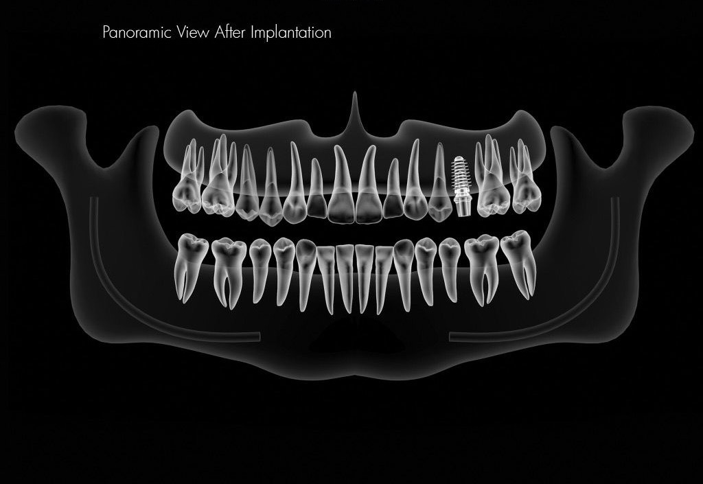 Single Posterior Implant 5