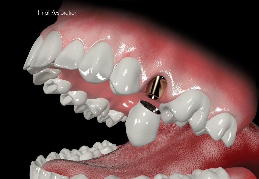 Single Posterior Implant 6
