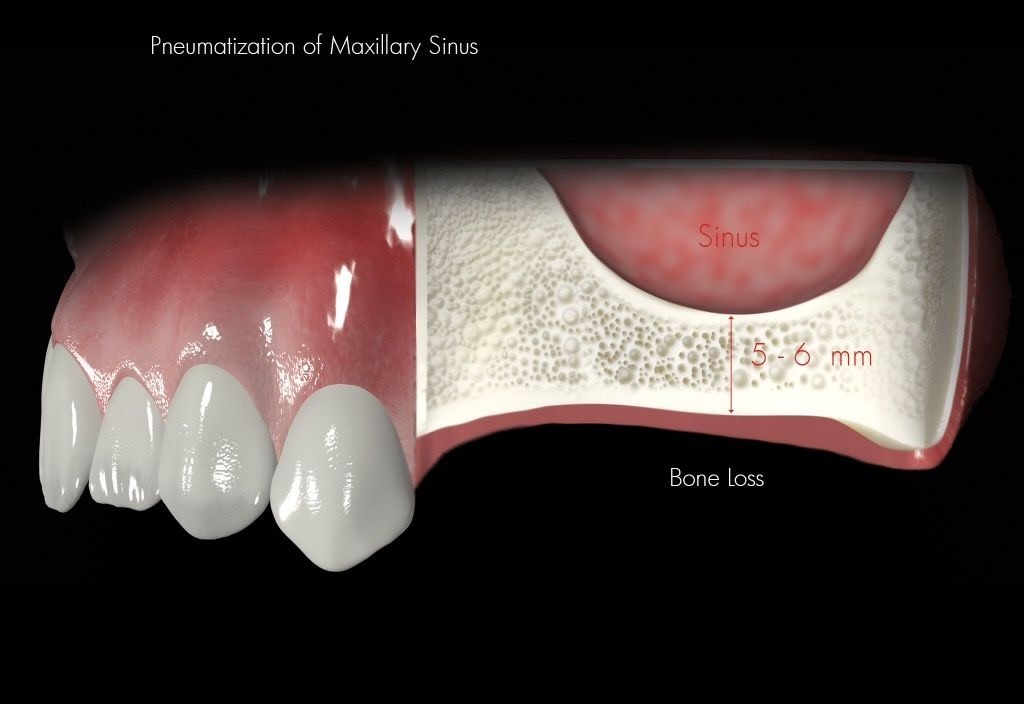 Sinus Lift 2