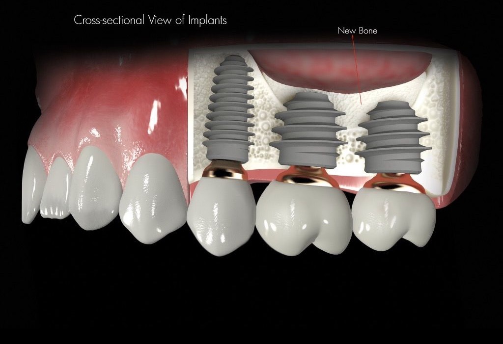 Sinus Lift 5